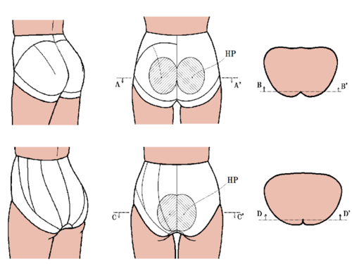 お尻のブラbuttocs Bra バトックスブラ の通販 特許取得の快適補正下着